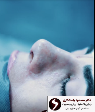 بعد عمل بینی ترمیمی بعد عمل بینی ترمیمی