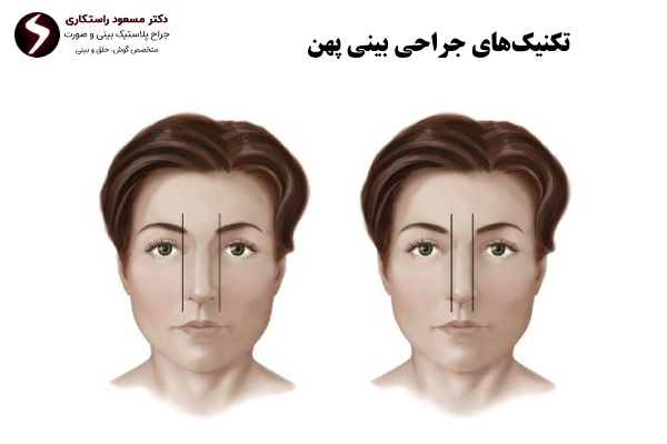تکنیک های جراحی بینی پهن تکنیک های جراحی بینی پهن