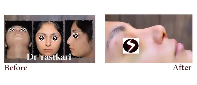 کاندیدای مناسب برای عمل بینی کاندیدای مناسب برای عمل بینی