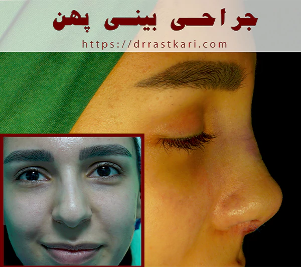 جراحی بینی پهن
