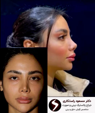 عمل بینی ترمیمی عمل بینی ترمیمی