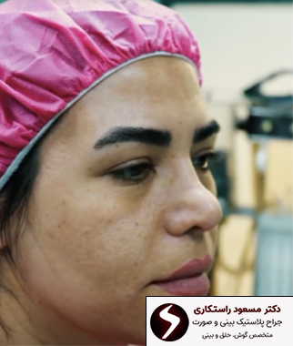 قبل از عمل بینی ترمیمی قبل از عمل بینی ترمیمی