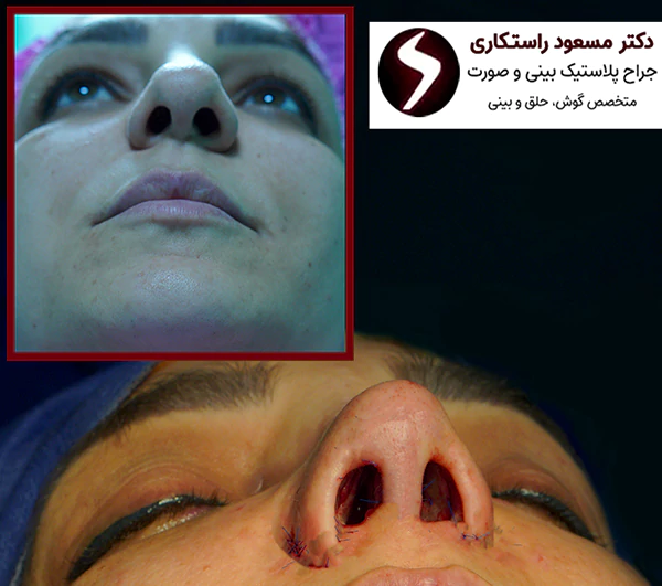 کاندیدای مناسب جراحی بینی پهن کاندیدای مناسب جراحی بینی پهن