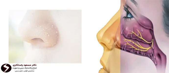 خشکی بینی بعد از جراحی بینی