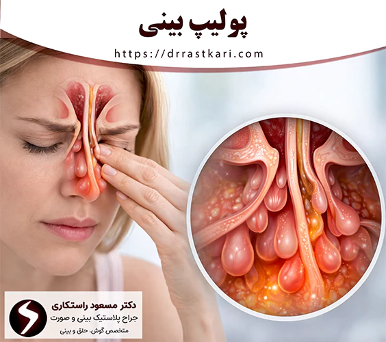 پولیپ بینی