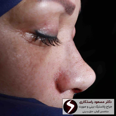 بعد از عمل بینی گوشتی
