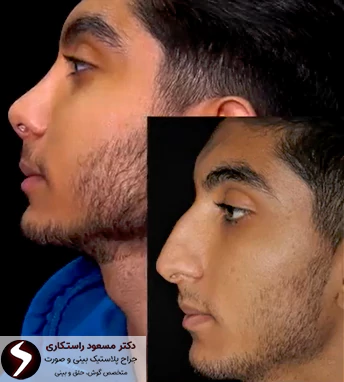 جراحی بینی آقایان