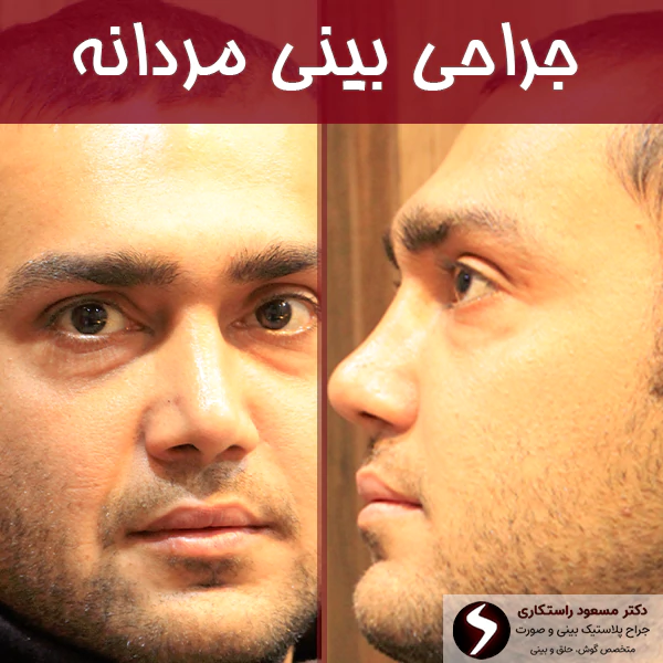 جراحی بینی مردانه