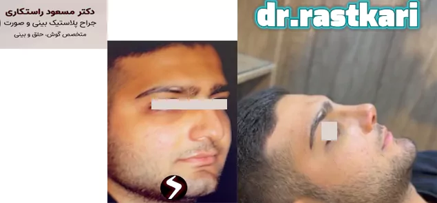 جراحی بینی و چانه اقایان همزمان