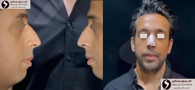 جراحی همزمان بینی با چانه مردان