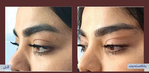 جراحی همزمان بینی و لیفت صورت جراحی همزمان بینی و لیفت صورت