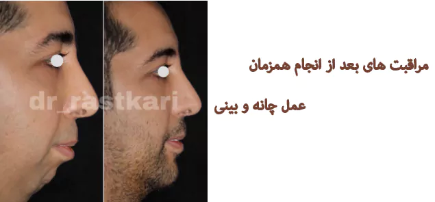 عمل همزمان چانه و بینی مردان