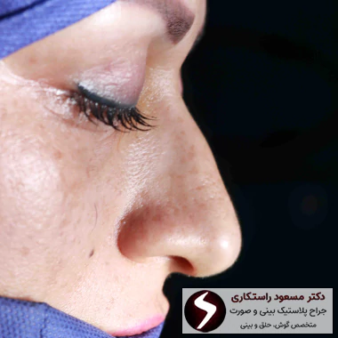 عکس قبل از عمل بینی