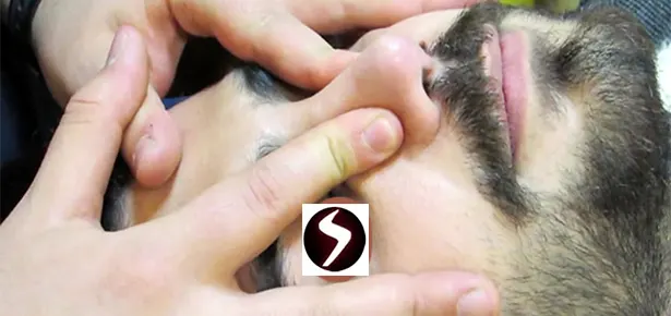 ماساژ بعد از جراحی بینی مردانه ماساژ بعد از جراحی بینی مردانه