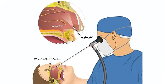 نکات مراقبتی بعد از اندوسکوپی سینوس
