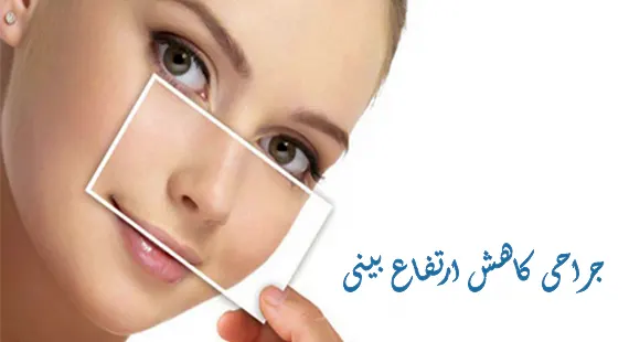 جراحی کاهش ارتفاع بینی