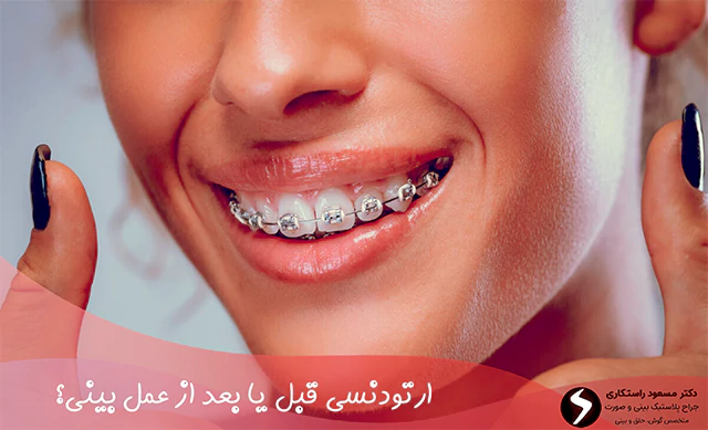 ارتودنسی قبل یا بعد از عمل بینی؟