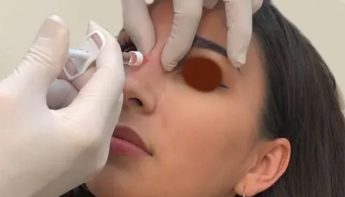 تزریق کورتون به نوک بینی