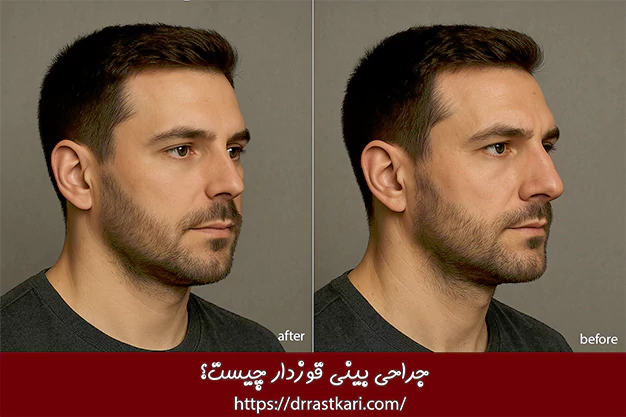 جراحی بینی قوزدار چیست؟ جراحی بینی قوزدار چیست؟