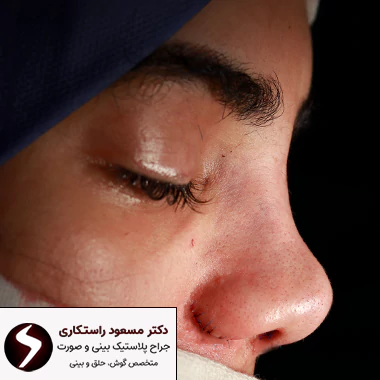 عکس عمل بینی