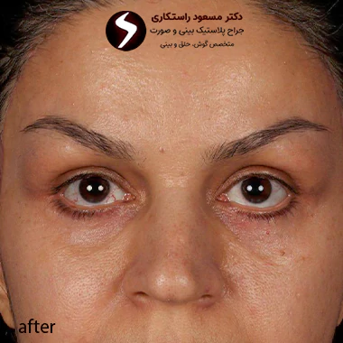بعد از جراحی لیفت شقیقه بعد از جراحی لیفت شقیقه