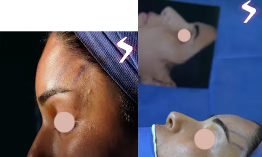 جراحی لیفت ابرو