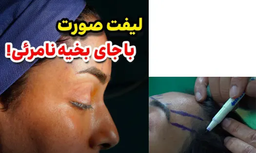 لیفت پیشانی با بخیه نامرئی لیفت پیشانی با بخیه نامرئی