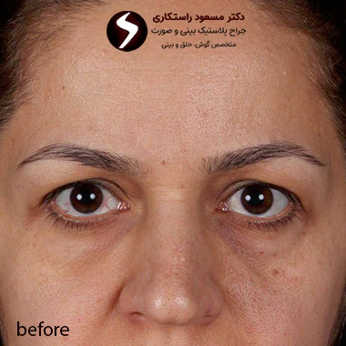 قبل از جراحی لیفت شقیقه قبل از جراحی لیفت شقیقه