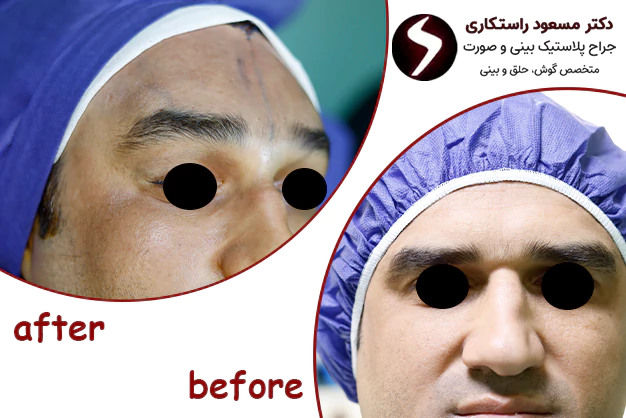 نمونه کار جراحی لیفت شقیقه