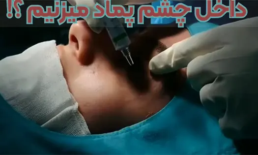 پماد زدن چشم قبل عمل بینی پماد زدن چشم قبل عمل بینی