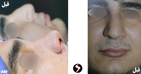 بینی گوشتی مردانه بینی گوشتی مردانه