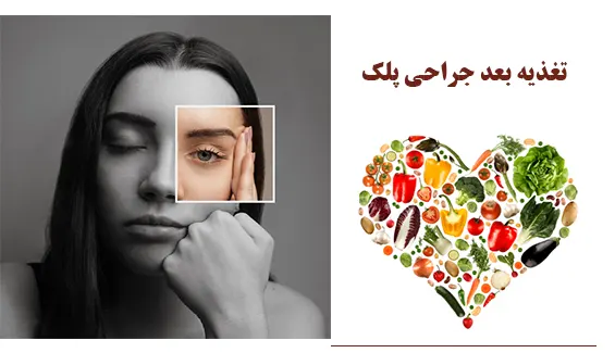تغذیه بعد جراحی پلک تغذیه بعد جراحی پلک
