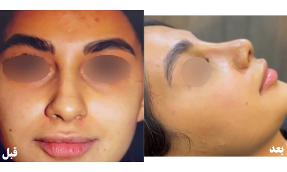 قبل و بعد عمل بینی گوشتی قبل و بعد عمل بینی گوشتی