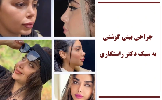 سبک جدید جراحی بینی گوشتی سبک جدید جراحی بینی گوشتی
