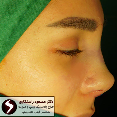 عکس بعد از جراحی بینی گوشتی