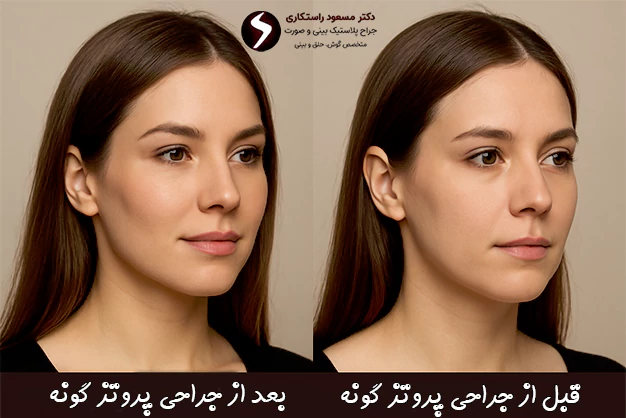 قبل و بعد جراحی پروتز گونه قبل و بعد جراحی پروتز گونه