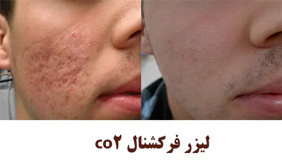 لیزر فرکشنال co2