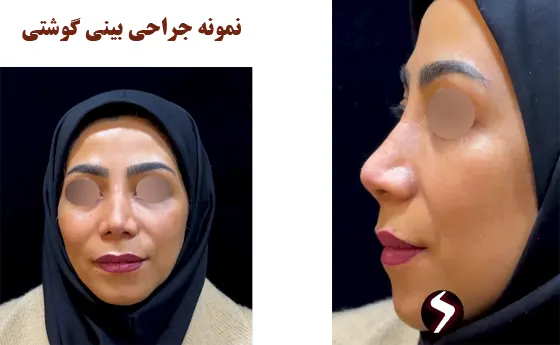 نمونه جراحی بینی گوشتی نمونه جراحی بینی گوشتی