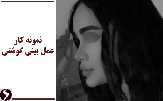 نمونه کار عمل بینی گوشتی نمونه کار عمل بینی گوشتی