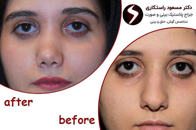 نمونه کار قبل و بعد جراحی بینی گوشتی نمونه کار قبل و بعد جراحی بینی گوشتی