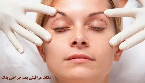 نکات مراقبتی بعد جراحی پلک نکات مراقبتی بعد جراحی پلک