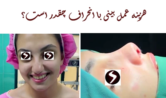 هزینه عمل بینی با انحراف چقدر است؟ هزینه عمل انحراف بینی