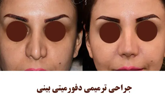 جراحی ترمیمی دفورمیتی بینی جراحی ترمیمی دفورمیتی بینی