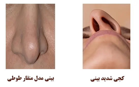 دفورمیتی های بینی دفورمیتی های بینی
