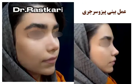 عمل بینی پیزوسرجری در تهران عمل بینی پیزوسرجری در تهران