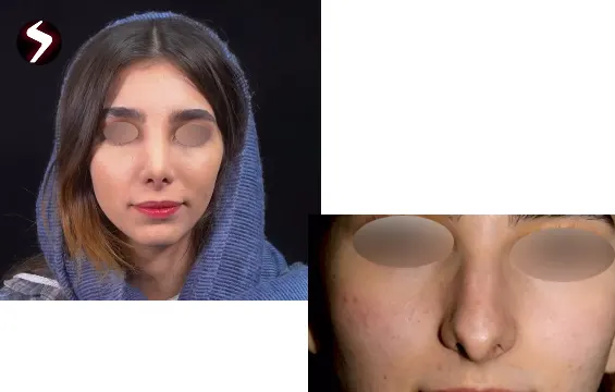 نمونه کار عمل بینی بدون تامپون