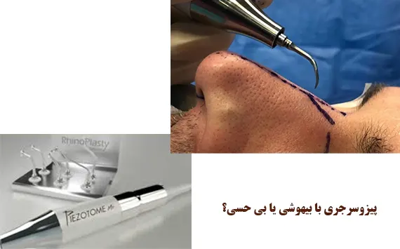 پیزوسرجری با بیهوشی یا بی حسی؟