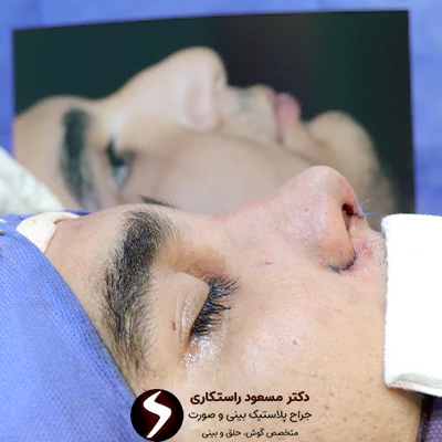 نمونه کار بهترین جراح بینی مردانه
