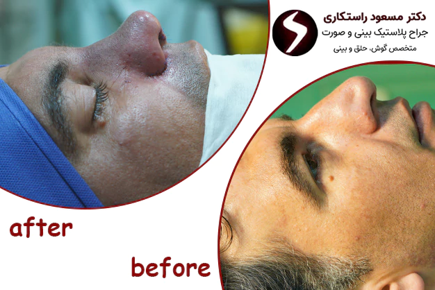 جراحی انحراف بینی جراحی انحراف بینی