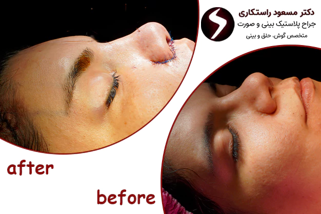 عمل انحراف بینی عمل انحراف بینی